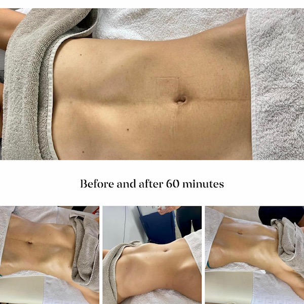 Lymfedrainage resultaten