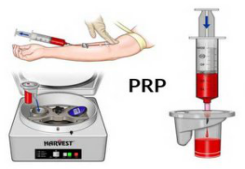 PRP behandeling